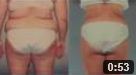 large volume liposuction
